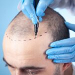 Derma Kalypsis Scalp Micropigmentation