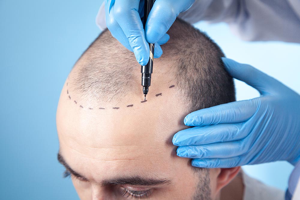 Derma Kalypsis Scalp Micropigmentation